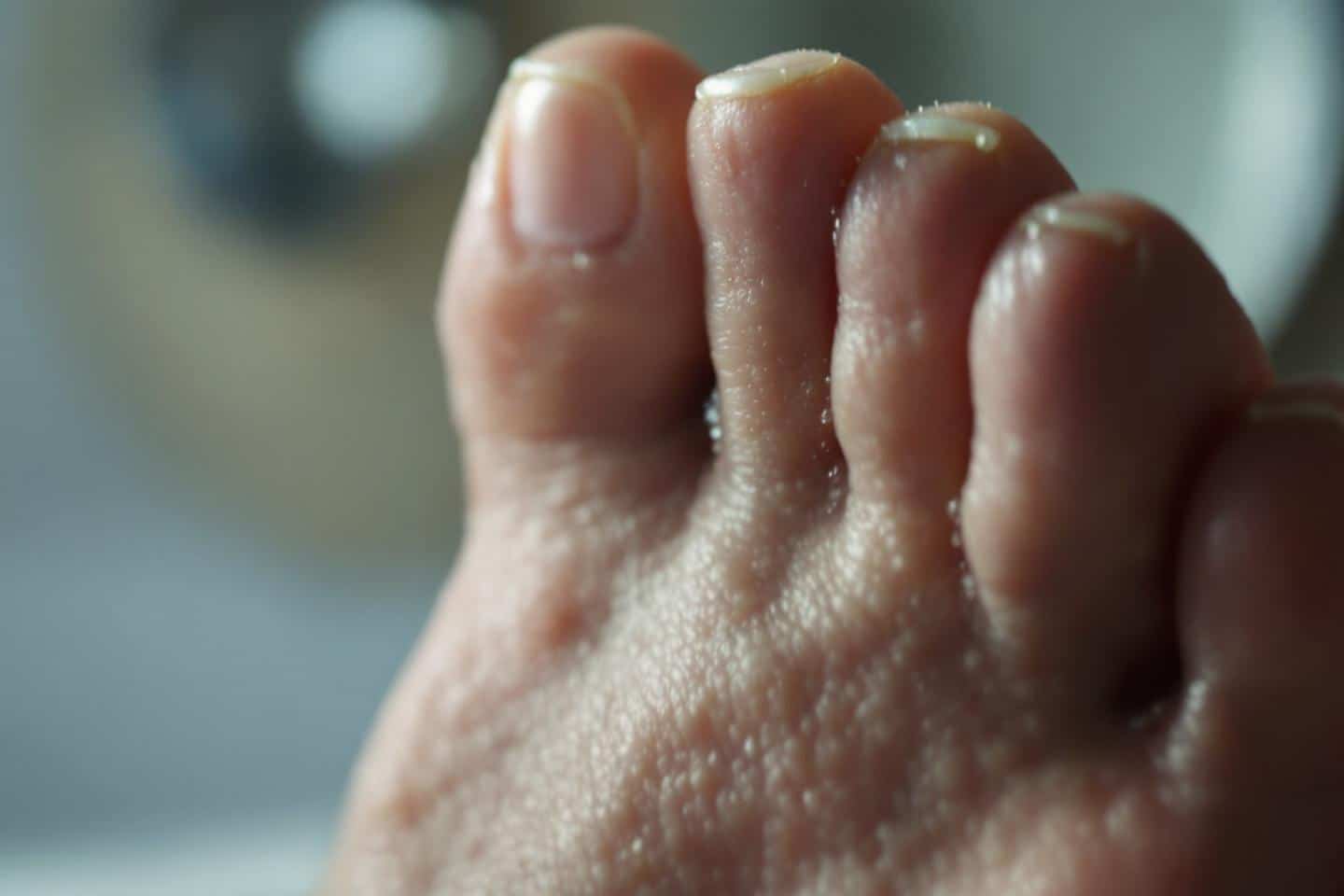 Verrues : Ce que cache leur apparition et comment s’en débarrasser efficacement